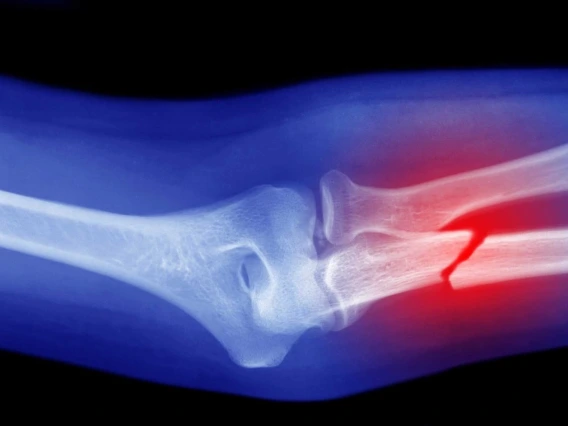 X-ray image showing a fractured human femur bone, highlighted with a red area at the site of the break against a blue background.