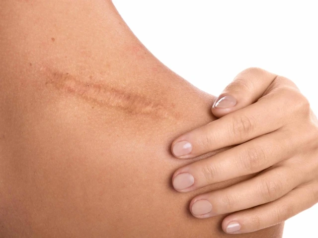 Close-up of a person's skin showing a prominent scar, with their hand gently resting on it.