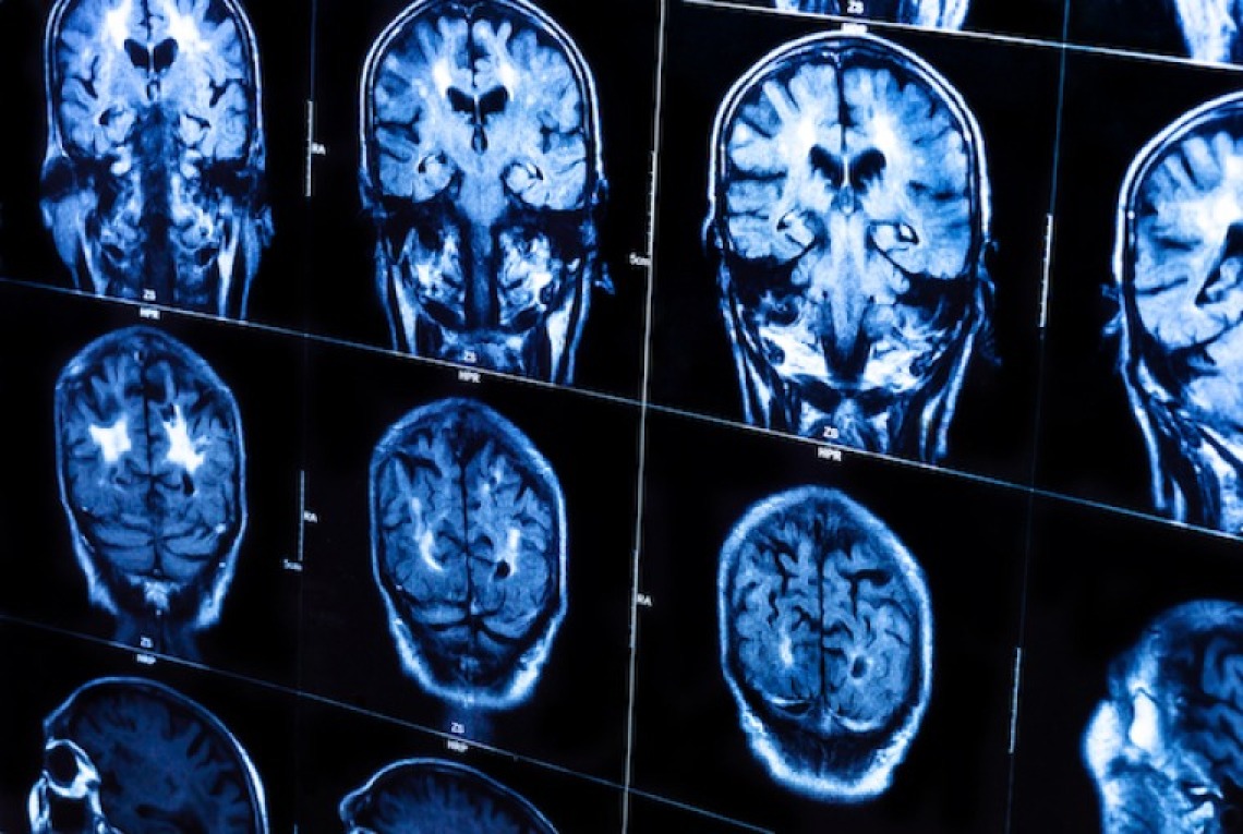 Brain imaging scans