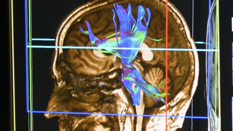 Multicolor image of brain in skull 