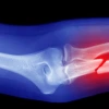 X-ray image showing a fractured human femur bone, highlighted with a red area at the site of the break against a blue background.
