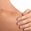 Close-up of a person's skin showing a prominent scar, with their hand gently resting on it.